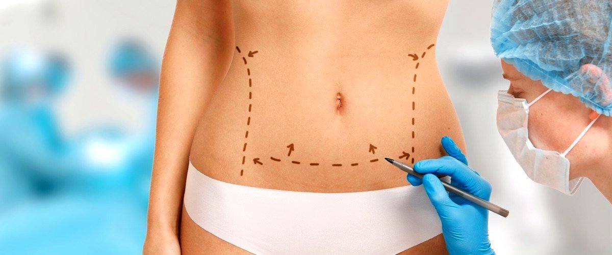 ¿Cuál es el proceso típico de una abdominoplastia en Marbella?