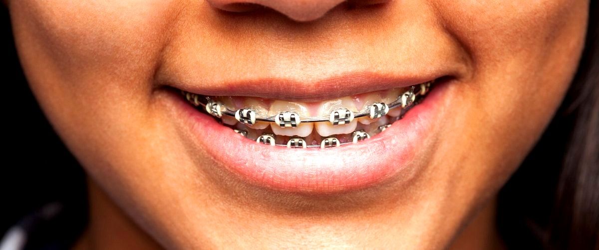 ¿Cuál es la edad mínima recomendada para utilizar Invisalign?