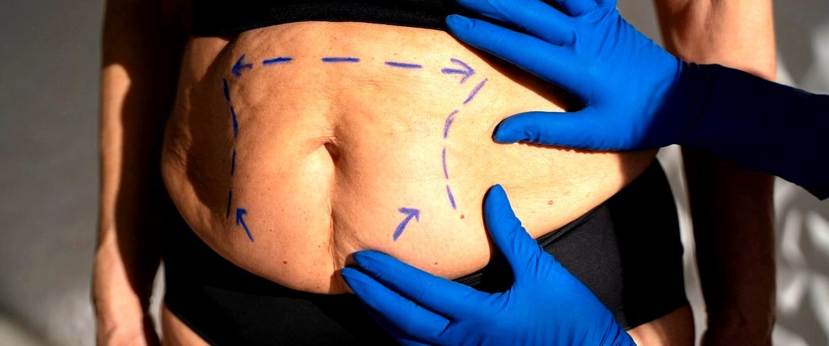 ¿Cuáles son los beneficios de la liposucción en San Sebastián?