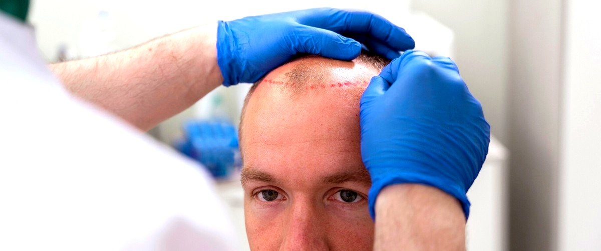 ¿Cuáles son los factores que influyen en el precio de un trasplante de cabello?